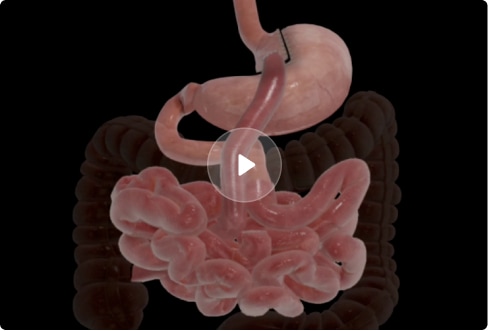 Gastric Bypass Surgery Video