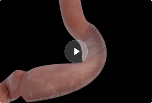 Gastric Sleeve Surgery Video